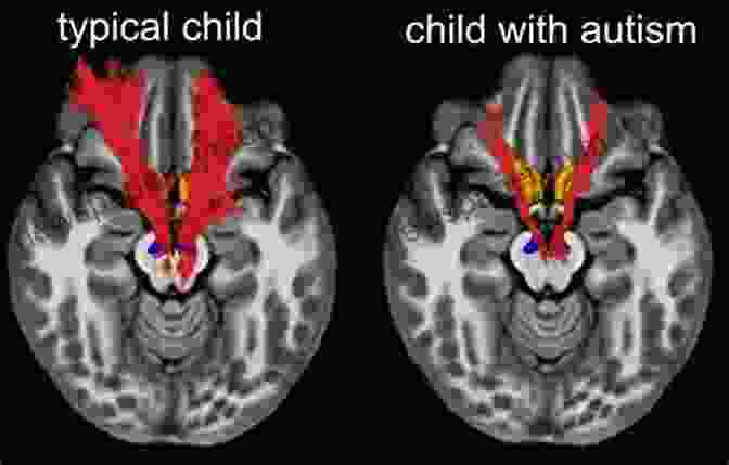 Brain Scan Showing Atypical Connectivity In Autism The Neurobiology Of Autism (The Johns Hopkins In Psychiatry And Neuroscience)